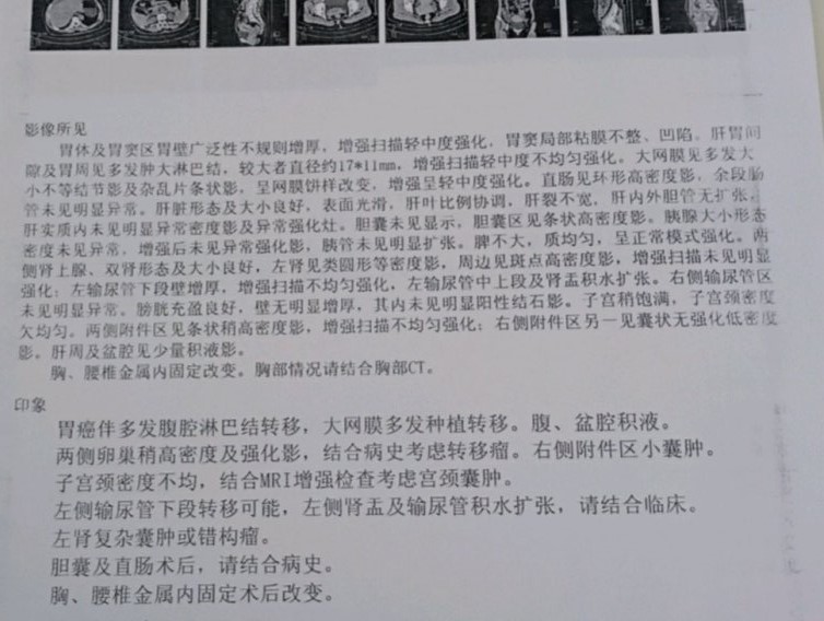 妈妈今年51岁，检查出来胃癌晚期，有没有了解的看下检测报告