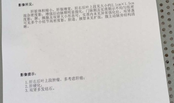 我妈的增强CT，肝癌严重到什么程度？