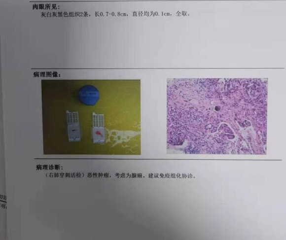 妈妈上月查出来肺癌晚期，名字叫腺癌，我该怎么办