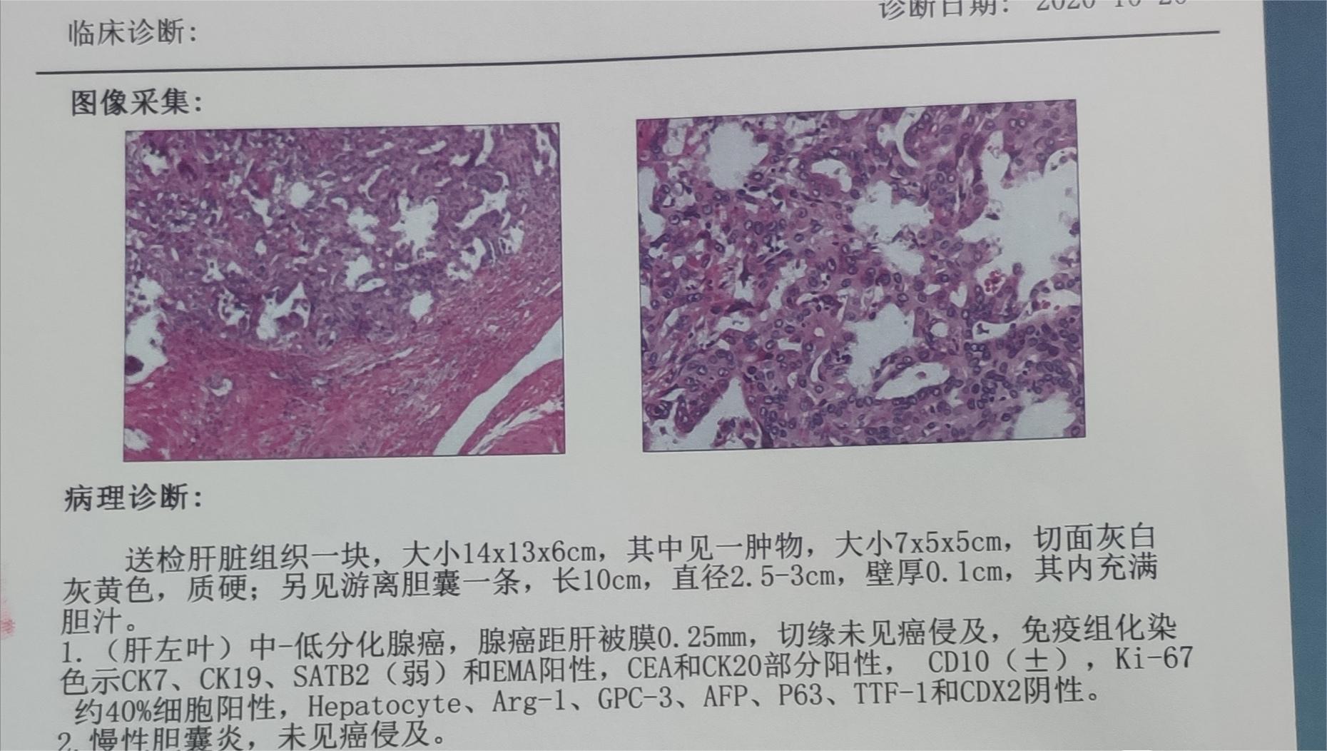 刚出的病理，看不明白，大家帮我解读一下